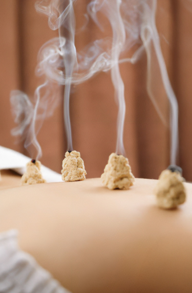 Glühende Moxa-Kegel über einem Akupunkturpunkt – traditionelle Wärmetherapie der TCM